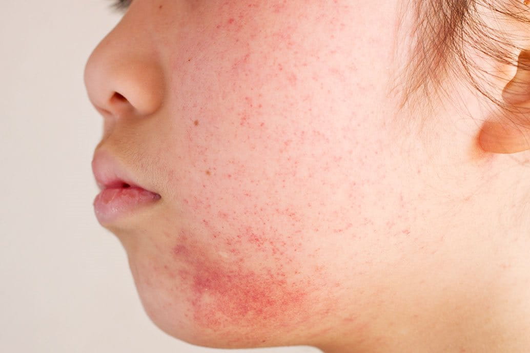 Dermatite Periorale cos’è, cause e cura Eucerin